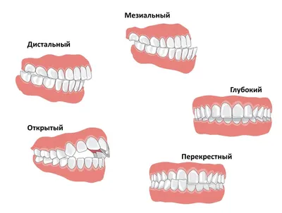 Заячья губа и волчья пасть - Блог проекта OMORFIA