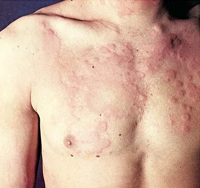 Varicella Зостер Шишки Волдыри И Струпья — стоковые фотографии и другие  картинки Болезни кожи - Болезни кожи, Ветрянка, Вид спереди - iStock