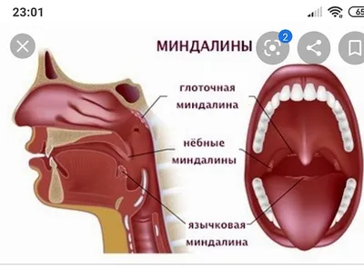 Как удалить гнойные пробки в горле лакун? | Беттертон