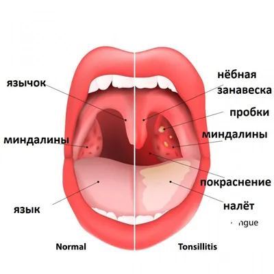 Таблетки для приготовления раствора для местного и наружного применения  Avexima Фурацилин Нитрофурал - «Фурацилин при гнойной ангине, при  воспалении горла и гнойных ранах. Эффективность, показания, побочки, способ  использования. » | отзывы