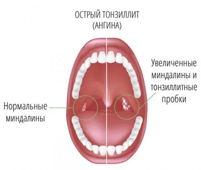 Удаление гнойных камней из миндалин - YouTube