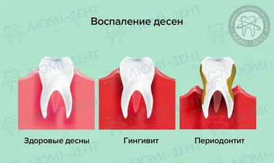 Воспалилась Десна 9 Советов Что Делать Киев ЛюмиДент