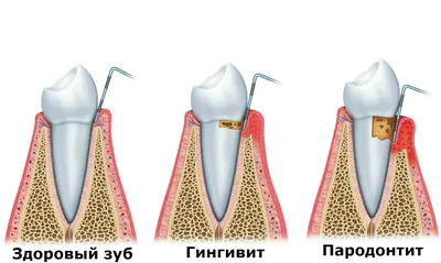 Воспаление десен: основные причины, симптомы и лечение