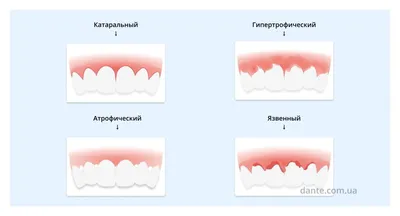 Все о воспалении десен: причины, типы заболеваний, симптомы, лечение —  D.Ante