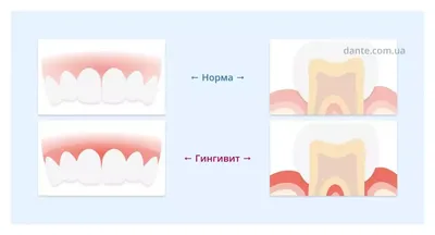 Лечение десен зубов в Хабаровске: цена, симптомы и методы лечения