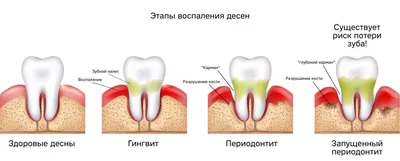 Лечение десен зубов - лечение пародонтита, лечение пародонтоза десен |  Пародонтология в Москве