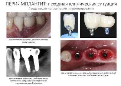 Лечение периимплантита за 8 шагов — CLINICIN.RU