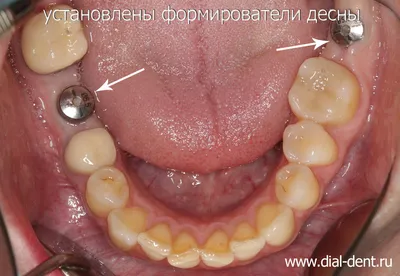 Имплантация двух нижних зубов с пластикой мягких тканей