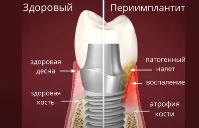 Периимплантит - лечение без удаления, симптомы и причины, фото