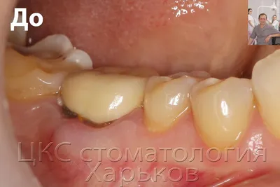 Пластика десны в Калининграде, услуга: методика, цены, акции, примеры