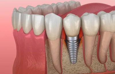 Имплантация зубов: достоинства и недостатки | Мир Улыбок