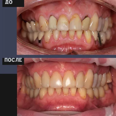 Имплантация зубов нижней и верхней челюсти в Челябинске: цены от Dominanta74