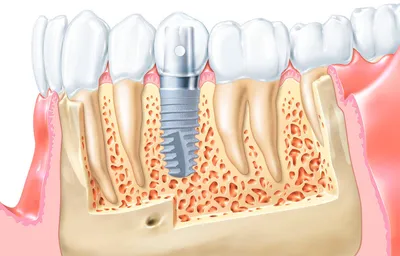 Виды и цены зубных имплантов – что это такое, классификация