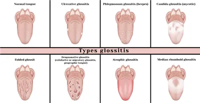 Красные пятна на языке: симптомы и лечение глоссита — ROOTT