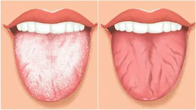 Налет на языке – норма или патология, причины и лечение