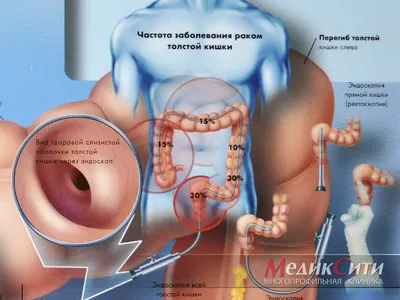 Инородное тело в кишечнике. Лечение: извлечение из кишечника инородных  предметов.