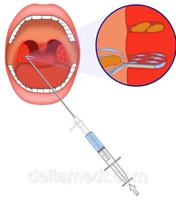 Как лечить хронический и острый тонзиллит: симптомы и препараты для  взрослых и детей