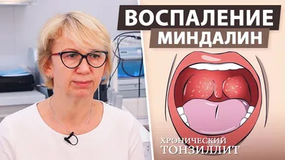 Как пережить восстановление после удаления миндалин - Лайфхакер