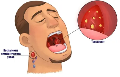 Тонзиллит- инфекционное воспаление миндалин