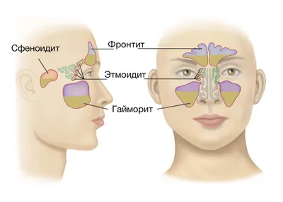 Синусит — РИНОС