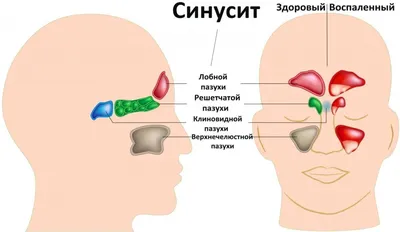 ИЗБАВЬСЯ ОТ ИНФЕКЦИИ НОСОВЫХ ПАЗУХ ВСЕГО ЗА 5 МИНУТ! Первые серьезные  холода уже успели застать многих из нас врасплох. Как результат —  ослабленный... | By Масажний кабінет Василя Закревського Health.in.touch |  Facebook