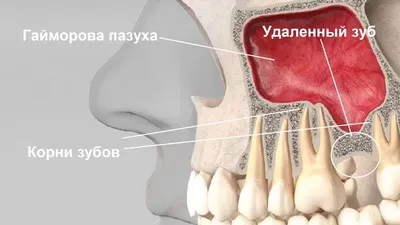 Фронтит: симптомы, лечение | Клиника Эксперт