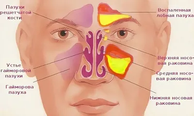 Острый синусит - это воспаление слизистой оболочки околоносовых пазух. ⠀  Риносинусит и синусит часто взаимозаменяемые, так как в основном… |  Instagram