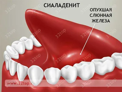 Осложнения при контурной пластике