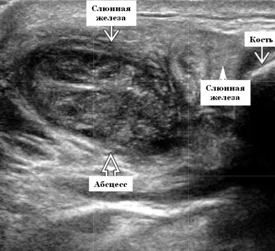 ≡ УЗИ слюнных желез ≻ сделать УЗИ слюнных желез в Киеве ≻ цена УЗИ слюнной  железы в клинике Доброго Доктора