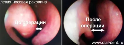 Прижигание слизистой носа для лечения вазомоторного ринита