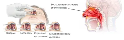 Полипы в носу - Что это такое? Симптомы, причины, диагности, лечение