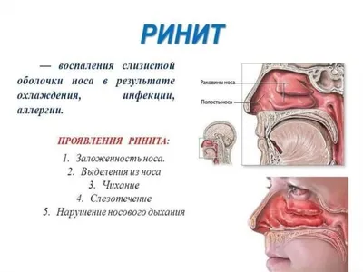 ▷ Ринит (воспаления слизистой оболочки носа): симптомы, причины и лечение