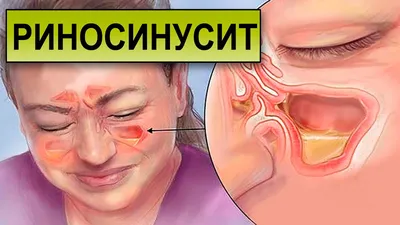 Воспаление слизистой носа, бесплатная консультация ветеринара - вопрос  задан пользователем Марина Николаева про питомца: кошка Без породы  (домашняя кошка)