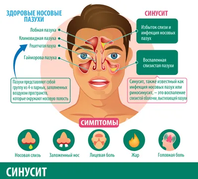 Ринофарингит: симптомы, лечение, причины у детей и взрослых