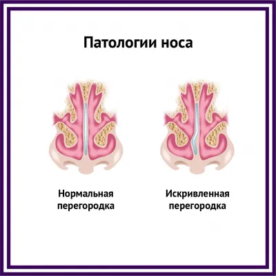 Остеопатия - Сегодня пост о хроническом рините и синусите. Они часто  встречаются у пациентов разного возраста. Синусит - от лат. sinus -- пазуха  и лат. -itis -- суффикс, означающий воспаление. Воспаление слизистой