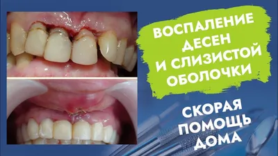 Влияние курения на здоровье полости рта - Государственное бюджетное  учреждение здравоохранения Астраханской области \"Областной клинический  стоматологический центр\"