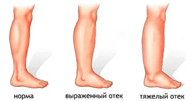 Васкулиты системные - причины появления, симптомы заболевания, диагностика  и способы лечения