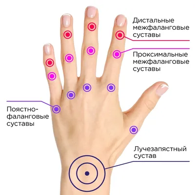 Артрит пальцев рук - симптомы и лечение воспаления суставов