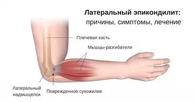 Первая Медицинская Клиника - Признаки артрита суставов пальцев рук: - боль  (поначалу возникает только при движениях, позднее может появляться и в  состоянии покоя); - дискомфорт и скованность в пораженных суставах кисти; -