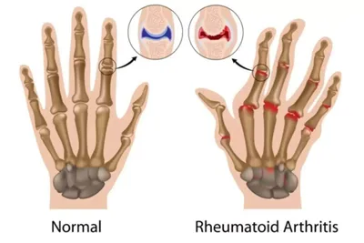Почему опухают кисти и болят суставы пальцев | Клиника Здоровья | Дзен