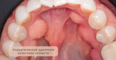 Стоматит у детей - причины, симптомы, признаки, диагностика, лечение,  профилактика