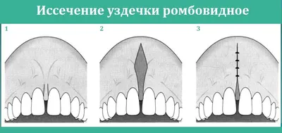 Прокол языка штанга | Пирсинг уздечки языка в Москве | «Пирсинг Вики» »