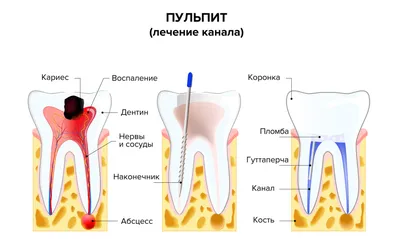 Свищ на десне: причины, как выявить и что делать? - DentBerg