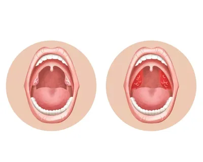 Тонзиллит - причины появления, симптомы заболевания, диагностика и способы  лечения