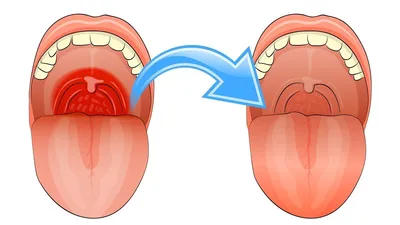 Лечение ангины у детей