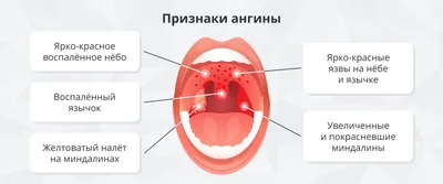 Фарингит | Симптомы, признаки, лечение воспаления глотки - Prodex