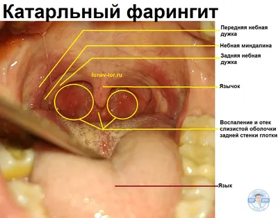 Фарингит у детей: симптомы, лечение, общие рекомендации