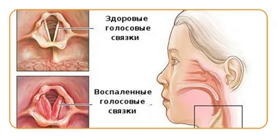 Фарингит - симптомы у взрослых и детей, что такое острый и хронический  фарингит, диагностика, лечение