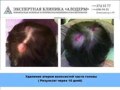 Атерома - причины, симптомы, диагностика и лечение в Москве