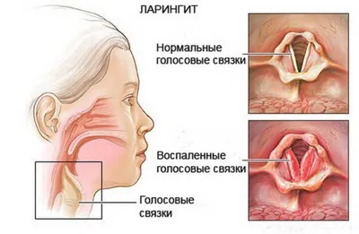 Воспаленное горло: симптомы, варианты лечения и особенности питания в  период болезни